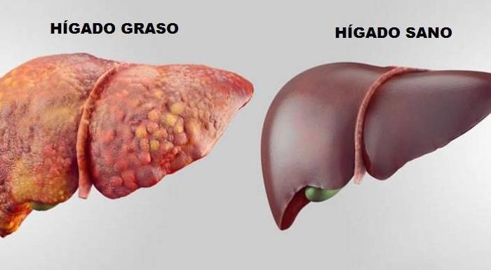 Consejos para limpiar el hígado graso sin demora